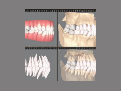 radiogyn-radiologia-clincheck-invisalign