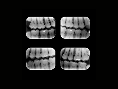 radiogyn-radiologia-interproximal