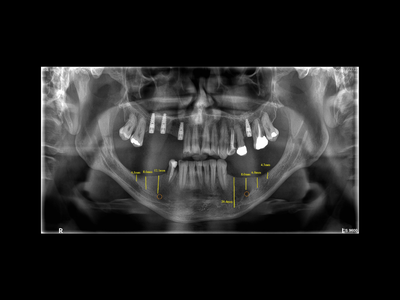 radiogyn-radiologia-panoramica-implante.png